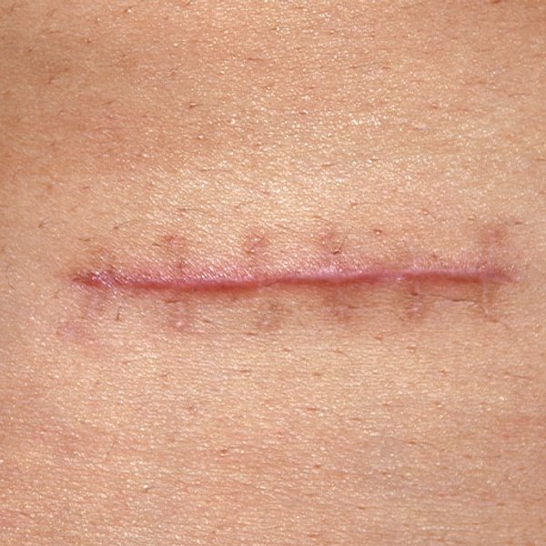Treating Scar Tissue: Causes And Prevention